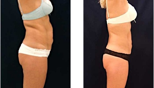 I-lipo: новое слово в похудении